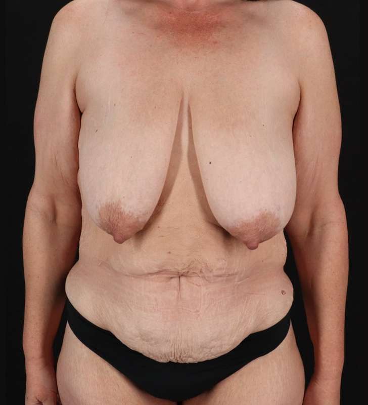 Breast Augmentation Before & After Patient #2389
