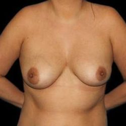 Breast Augmentation Before & After Patient #2396