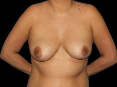 Breast Augmentation Before & After Patient #2396