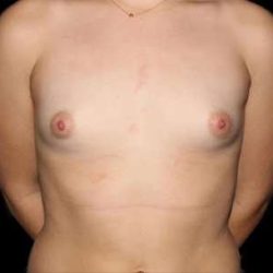 Breast Augmentation Before & After Patient #2403