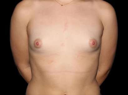 Breast Augmentation Before & After Patient #2403