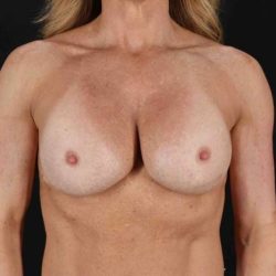 Breast Implant Revision Before & After Patient #2436