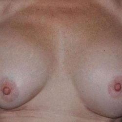 Breast Implant Revision Before & After Patient #2441