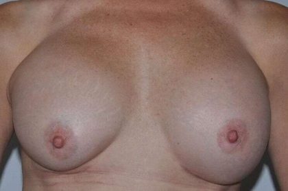 Breast Implant Revision Before & After Patient #2441