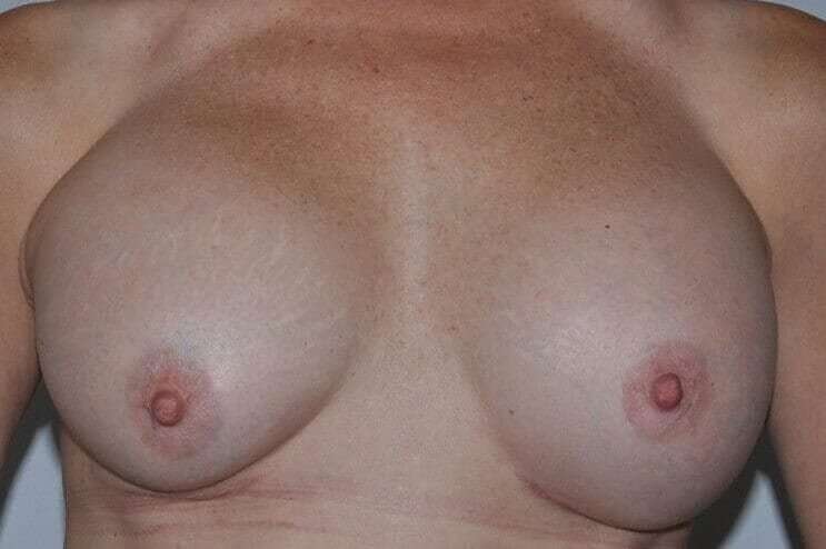 Breast Implant Revision Before & After Patient #2441