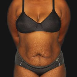Abdominoplasty (Tummy Tuck) Before & After Patient #568