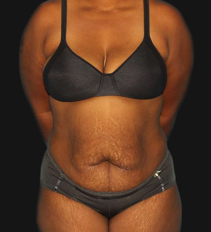 Abdominoplasty (Tummy Tuck) Before & After Patient #568