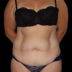 Abdominoplasty (Tummy Tuck) Before & After Patient #768