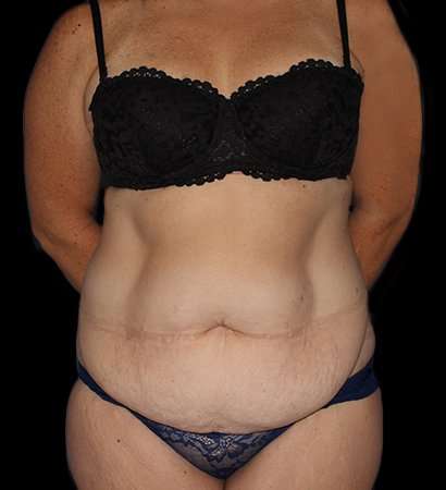 Abdominoplasty (Tummy Tuck) Before & After Patient #768