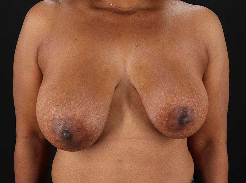 Breast Reduction Before & After Patient #2452