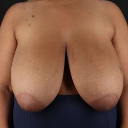 Breast Reduction Before & After Patient #2463