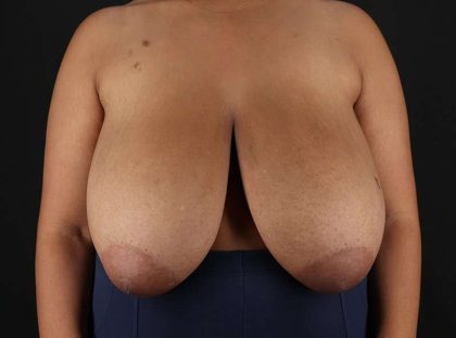 Breast Reduction Before & After Patient #2463
