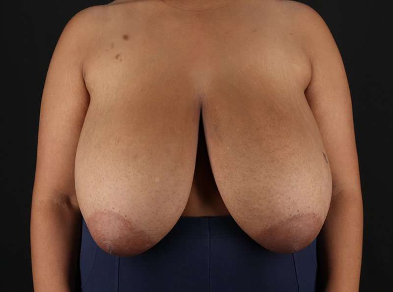 Breast Reduction Before & After Patient #2463