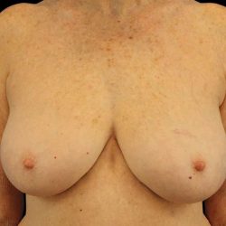 Breast Reduction Before & After Patient #2474