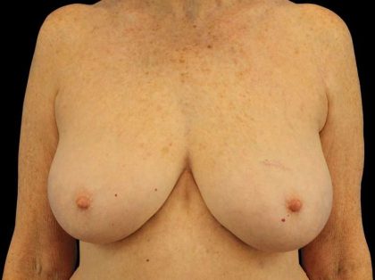 Breast Reduction Before & After Patient #2474