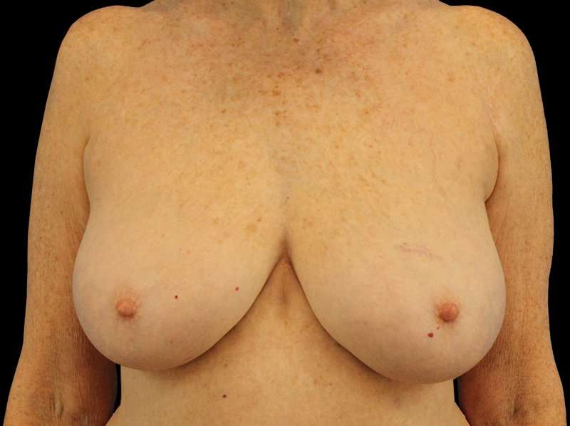 Breast Reduction Before & After Patient #2474