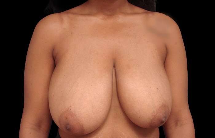 Breast Reduction Before & After Patient #2514