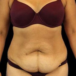Abdominoplasty (Tummy Tuck) Before & After Patient #779
