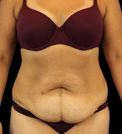 Abdominoplasty (Tummy Tuck) Before & After Patient #779