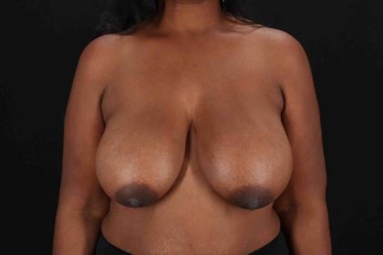 Breast Reduction Before & After Patient #2591