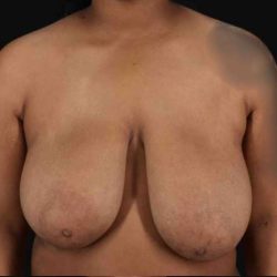 Breast Reduction Before & After Patient #2602