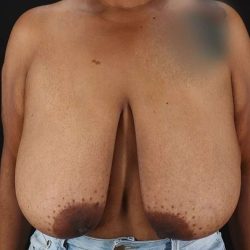 Breast Reduction Before & After Patient #2646