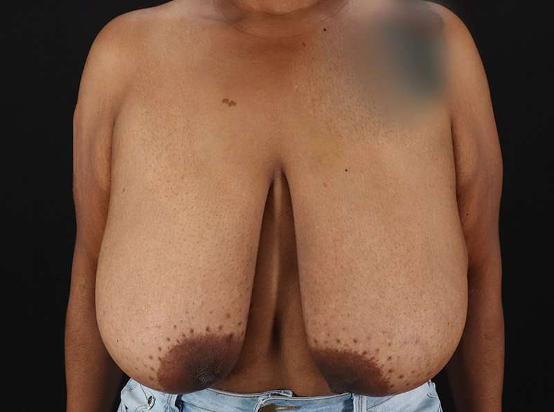 Breast Reduction Before & After Patient #2646