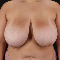 Breast Reduction Before & After Patient #2657