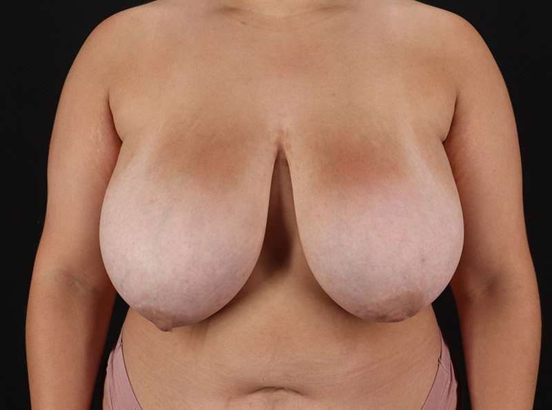 Breast Reduction Before & After Patient #2657