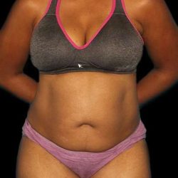 Abdominoplasty (Tummy Tuck) Before & After Patient #790