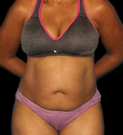 Abdominoplasty (Tummy Tuck) Before & After Patient #790