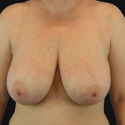 Breast Reduction Before & After Patient #2664