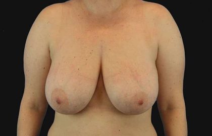 Breast Reduction Before & After Patient #2664