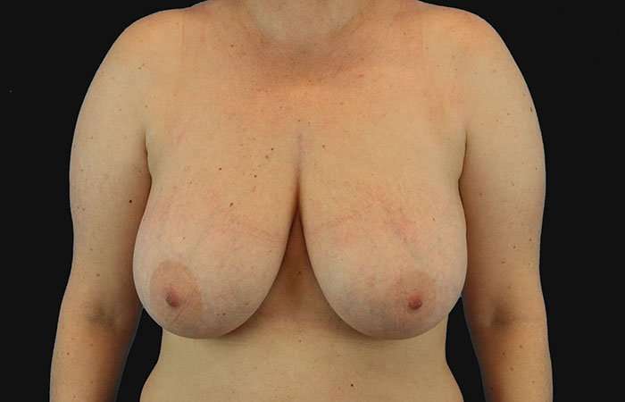 Breast Reduction Before & After Patient #2664