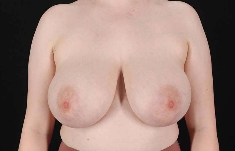 Breast Reduction Before & After Patient #2687