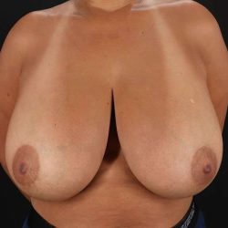 Breast Reduction Before & After Patient #2718