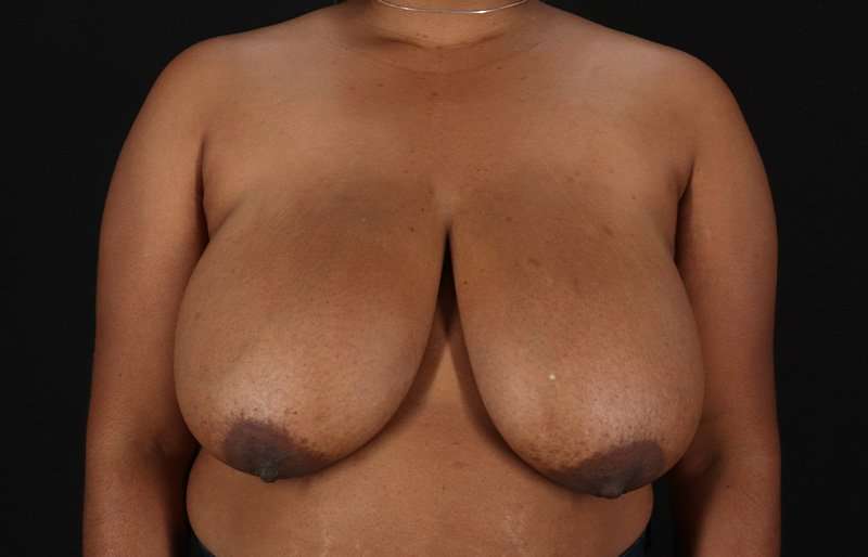 Breast Reduction Before & After Patient #2824