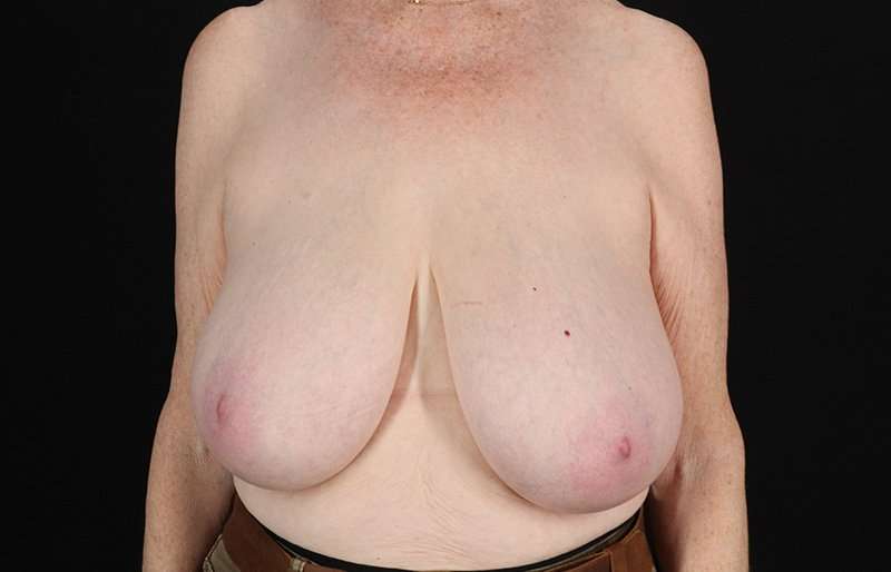 Breast Reduction Before & After Patient #2836