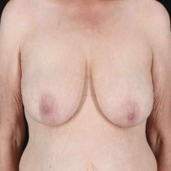 Breast Reduction Before & After Patient #2847