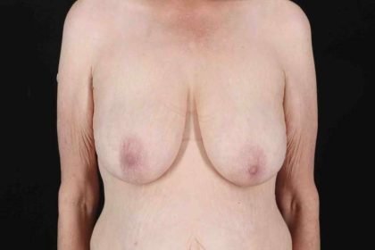 Breast Reduction Before & After Patient #2847