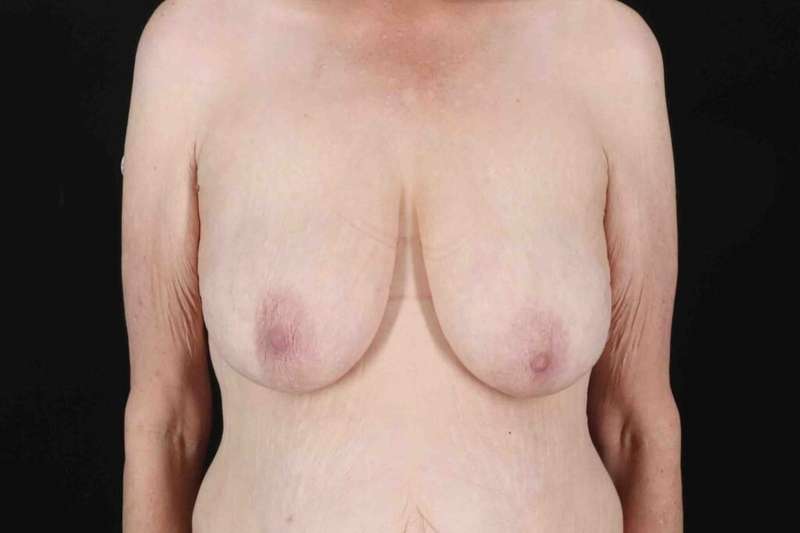 Breast Reduction Before & After Patient #2847