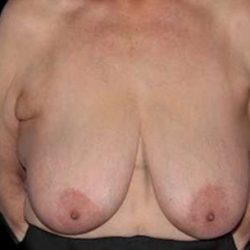 Breast Reduction Before & After Patient #2859