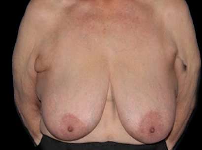 Breast Reduction Before & After Patient #2859