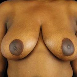 Breast Reduction Before & After Patient #2870