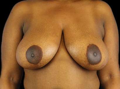 Breast Reduction Before & After Patient #2870