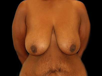 Breast Reduction Before & After Patient #2881