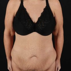 Abdominoplasty (Tummy Tuck) Before & After Patient #817