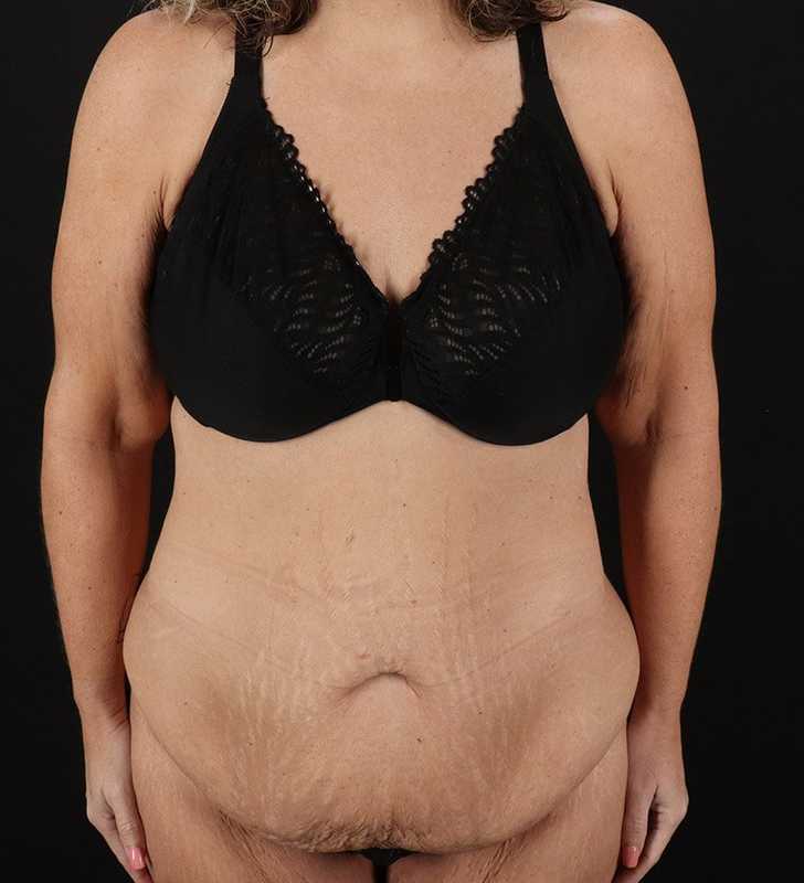 Abdominoplasty (Tummy Tuck) Before & After Patient #817