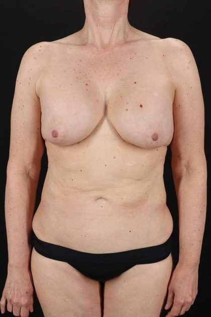 All Me Augmentation Before & After Patient #2914