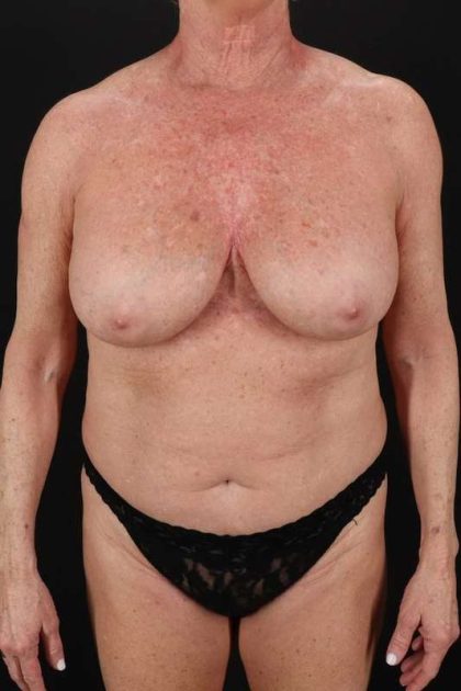 All Me Augmentation Before & After Patient #2921